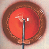 capsulorhexis