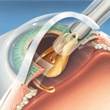 implantation of foldable intraocular lens