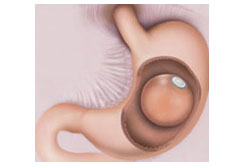Intragastric Balloon Intragastric Balloon